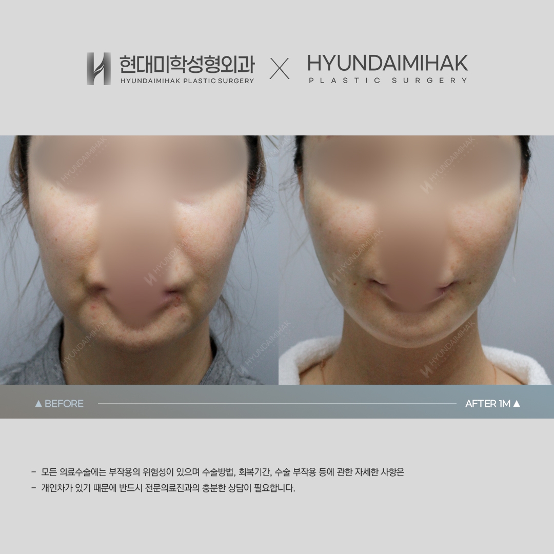 [ศัลยกรรมหน้าเด็ก] ร้อยไหม 1 เดือน