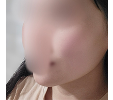 ดูดไขมันหน้า+ร้อยไหม!!