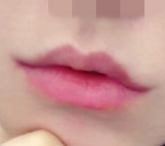 ผ่าตัดมุมปากแล้วมั่นใจขึ้นมากเลย ㅋㅋ
