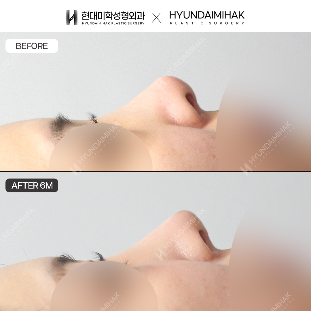 [แก้จมูกซ้ำ] สันจมูก + ปลายจมูก ครบ 6 เดือน