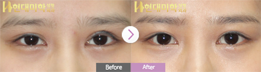 แก้ตาแบบกรีด, ปรับกล้ามเนื้อตา
