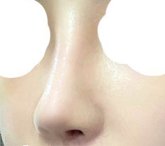 ผ่าตัดจมูกสำเร็จในครั้งเดียว