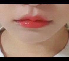 ผ่าตัดยกมุมปากคิวปิด~>3<♡