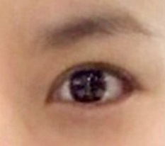 แก้ตาครบหนึ่งเดือน ได้ขนาดนี้ถือว่าสำเร็จแล้วค่ะ