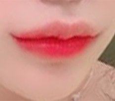 Mouth-corner surgery was a huge success