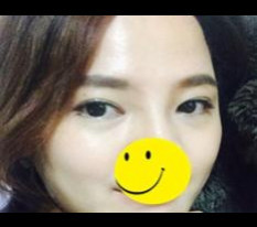 รีวิวผ่าตัดหัวตาและดูอัลคอร์เนอร์