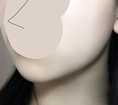 จัดการเหนียงเรียบร้อย