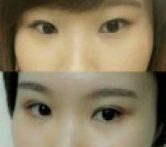 ทำไมเพิ่งมาทำผ่าตัดตาตอนนี้ ㅋㅋ