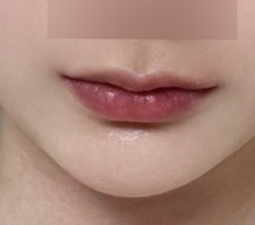 โชคดีมากที่ผ่าตัดยกมุมปาก ฮ่าๆ