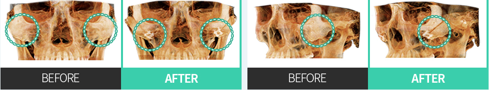 CASE 02 การจัดตำแหน่งไปด้านหลังและด้านบน — เปรียบเทียบ CT BEFORE / AFTER ด้านหน้า·ด้านข้าง