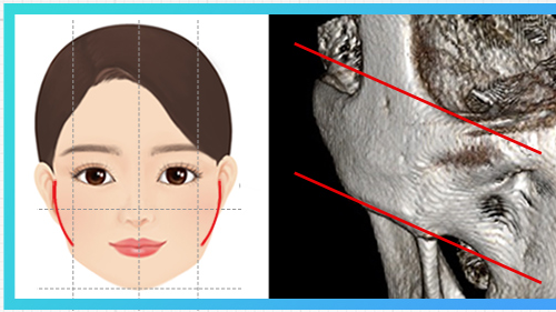 ประเภทโหนกแก้มโดยรวมกว้าง — แผนภาพโหนกแก้ม + CT
