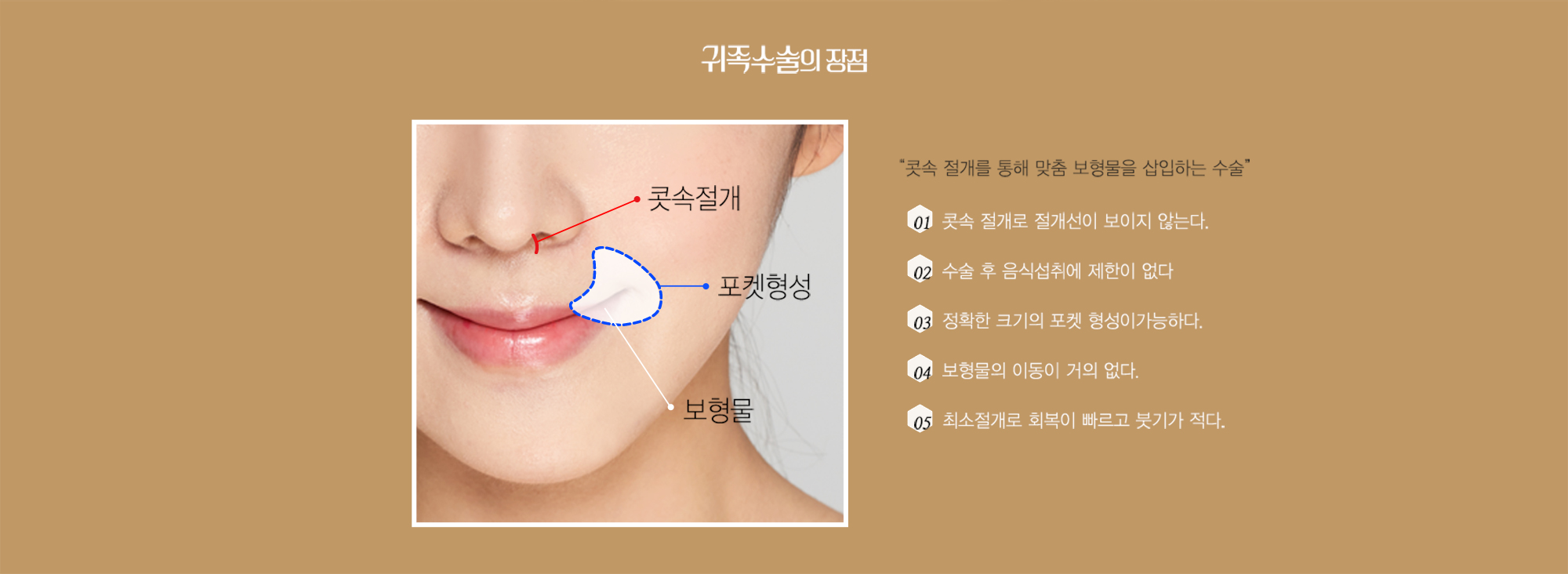 ข้อดีของการผ่าตัดเสริมร่องแก้ม — แผนภาพการผ่าตัดภายในจมูก การสร้างช่องว่าง และวัสดุเสริม พร้อมข้อดี 5 ประการ