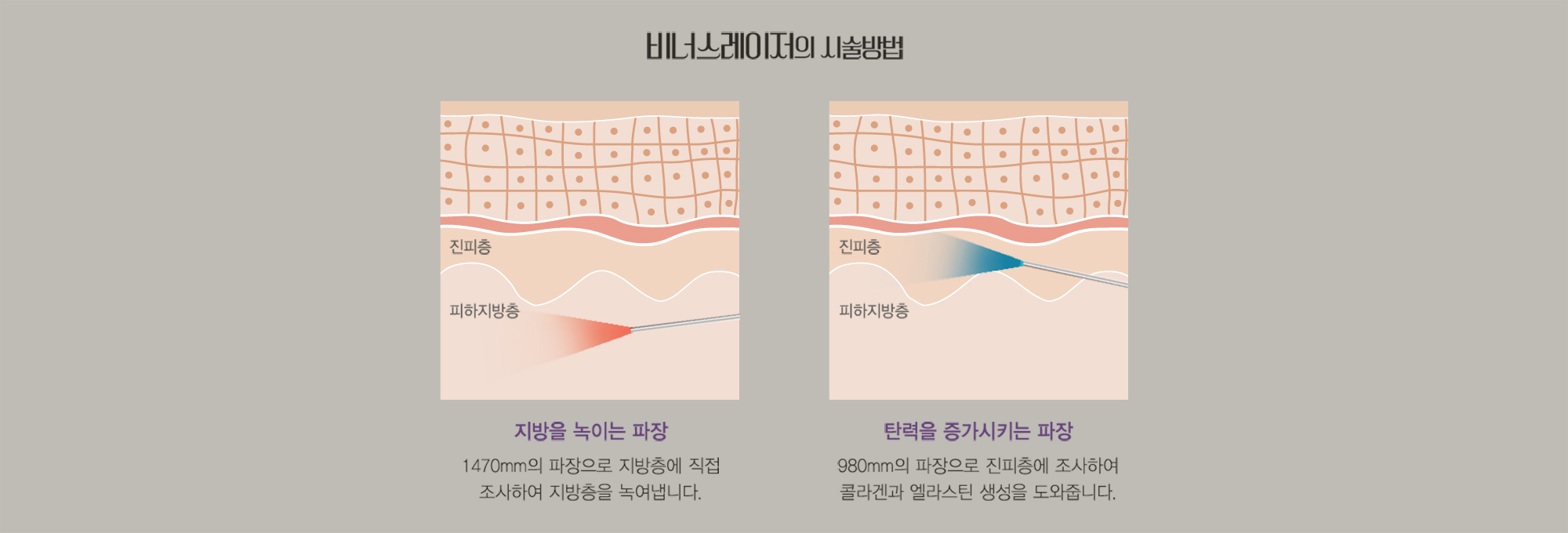 วิธีการรักษาด้วย Venus Laser — แผนภาพหน้าตัดชั้นหนังแท้·ชั้นไขมันใต้ผิวหนัง และคำอธิบายสองความยาวคลื่น