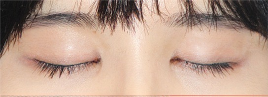 ภาพเปรียบเทียบก่อนและหลังทำ Ten Minute Natural Adhesion 2