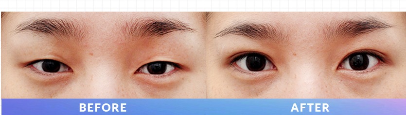 ภาพโพสต์ Instagram เปรียบเทียบดวงตาก่อนและหลัง Ten Minute Natural Adhesion