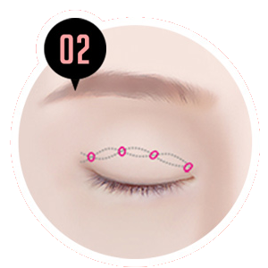 ภาพประกอบดวงตา ขั้นตอน STEP 02 การผ่าตัด Ten Minute Natural Adhesion