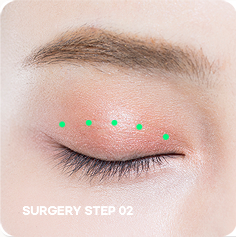 ภาพขั้นตอน STEP 02 ของการแก้ไขตาแบบไม่กรีด ขั้นตอนสร้างรูขนาดเล็ก