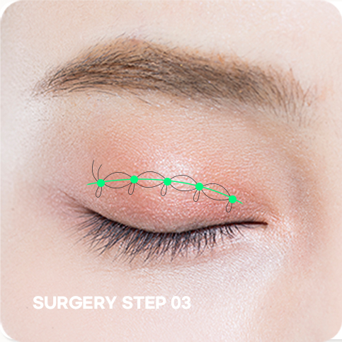 ภาพขั้นตอน STEP 03 ของการแก้ไขตาแบบไม่กรีด ขั้นตอนวางแผนการผ่าตัด