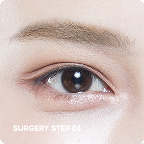 ภาพขั้นตอน STEP 04 ของการแก้ไขตาแบบไม่กรีด ขั้นตอนผ่าตัดเสร็จสิ้น