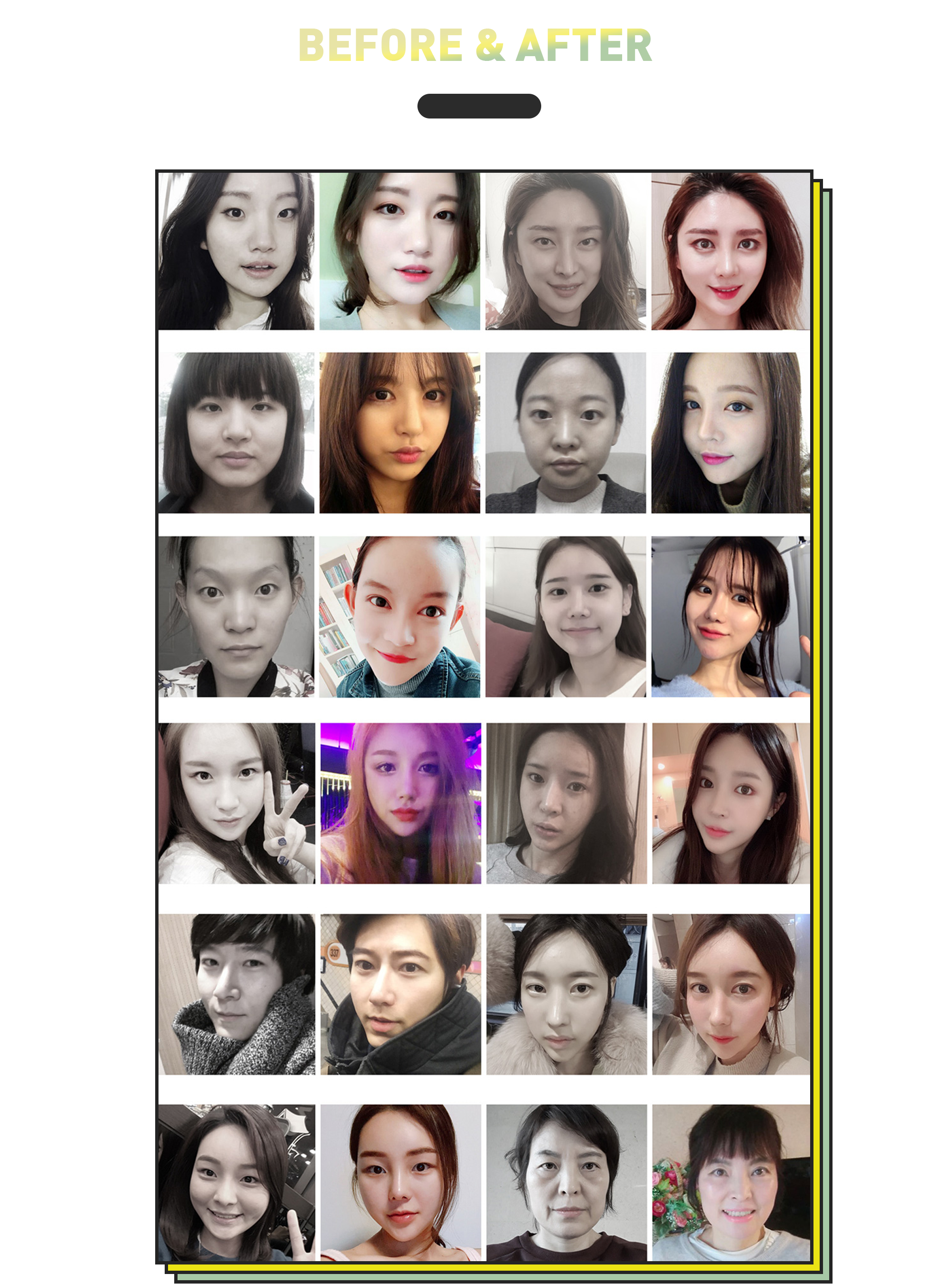 BEFORE & AFTER — รวมภาพเปรียบเทียบก่อนและหลังการผ่าตัดยกคิ้ว (หลังผ่าตัด 3 เดือน)
