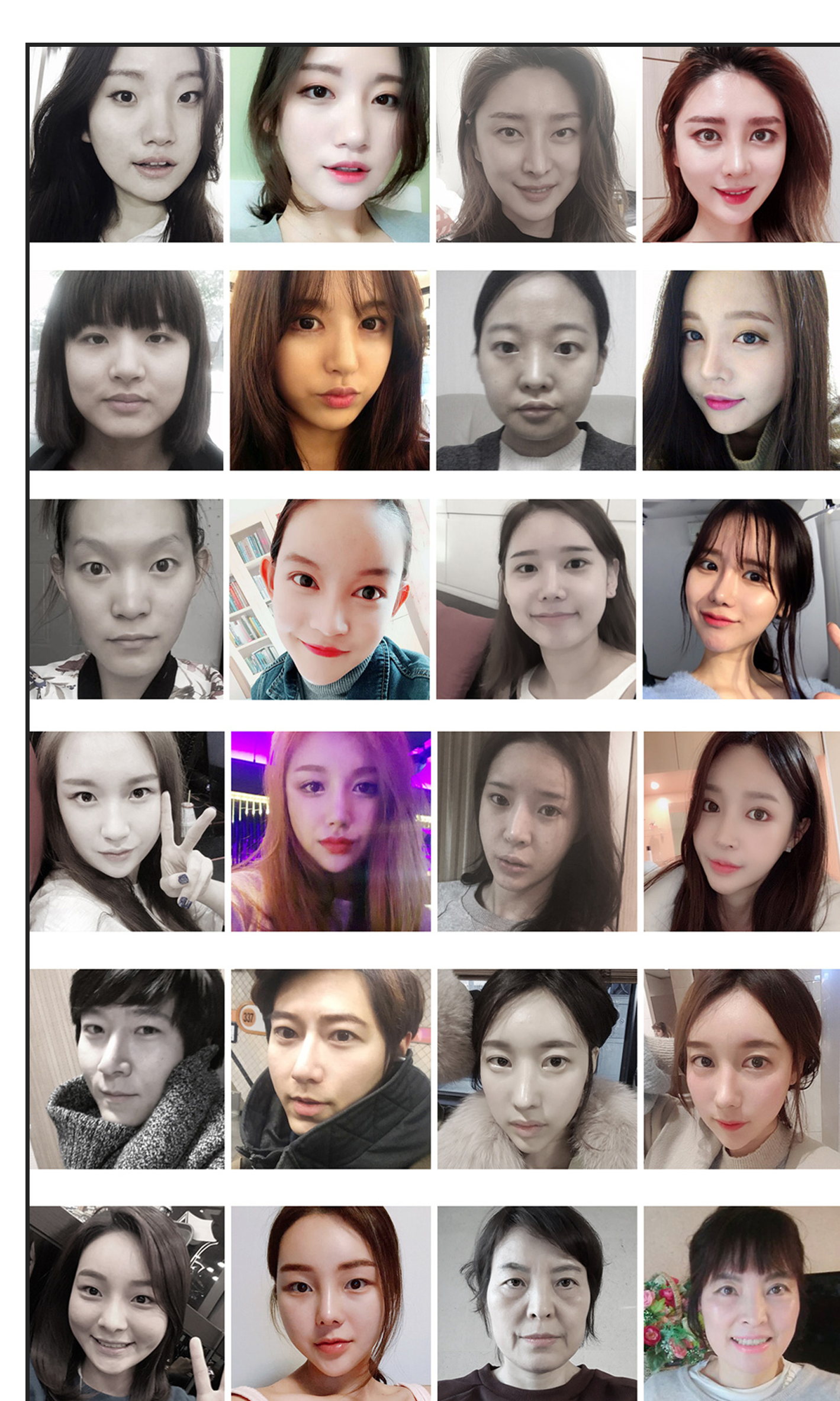 ศัลยกรรมแก้ไขการเปิดหัวตา/หางตา H-Mihak BEFORE & AFTER