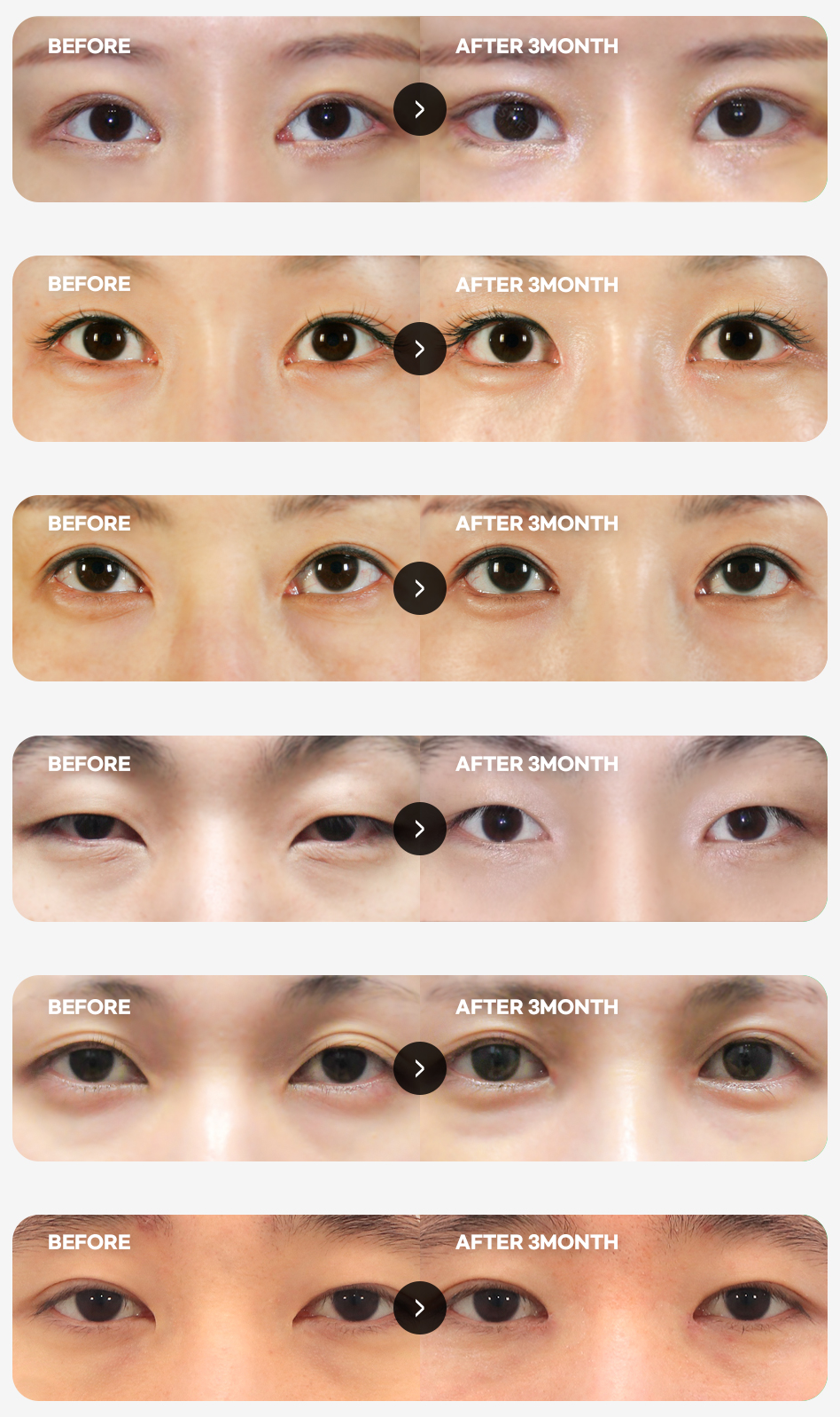 การฟื้นฟูหลังเปิดหัวตาของ H-Mihak Thailand BEFORE&AFTER — เปรียบเทียบก่อนและหลัง 6 คู่