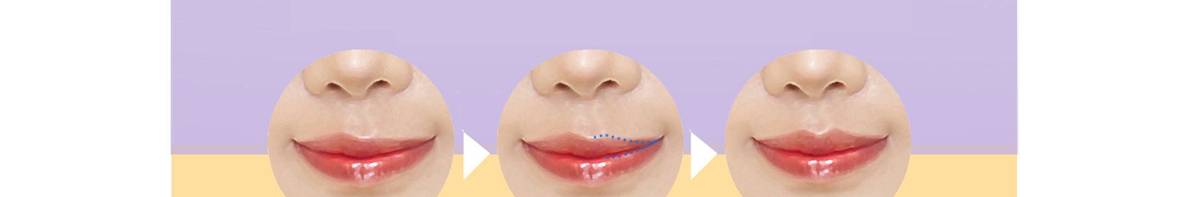 ก่อนและหลังการแก้ไข Cupid's bow / เส้นขอบริมฝีปากไม่สมมาตร