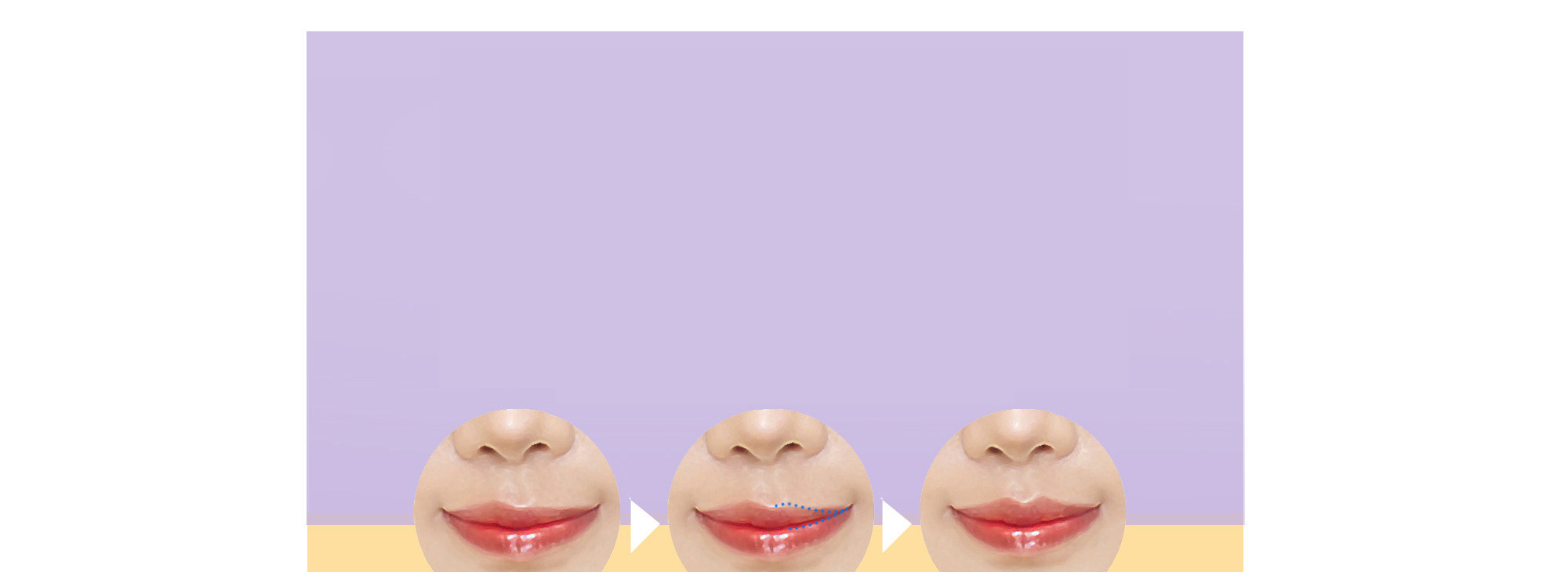 การแก้ไข Cupid's bow / เส้นขอบริมฝีปากไม่สมมาตร