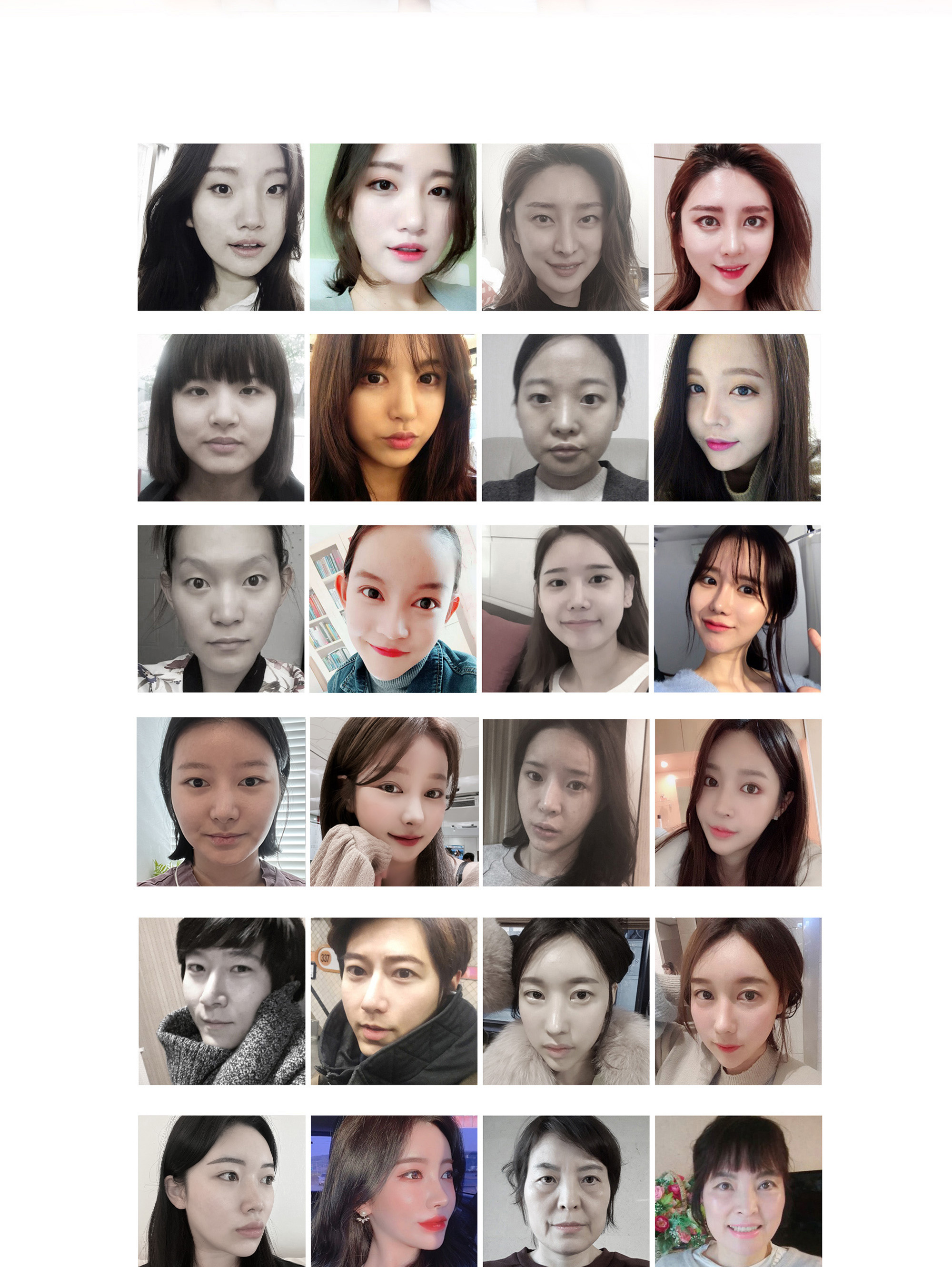 เคส Before & After การแก้ไขริมฝีปากไม่สมมาตร