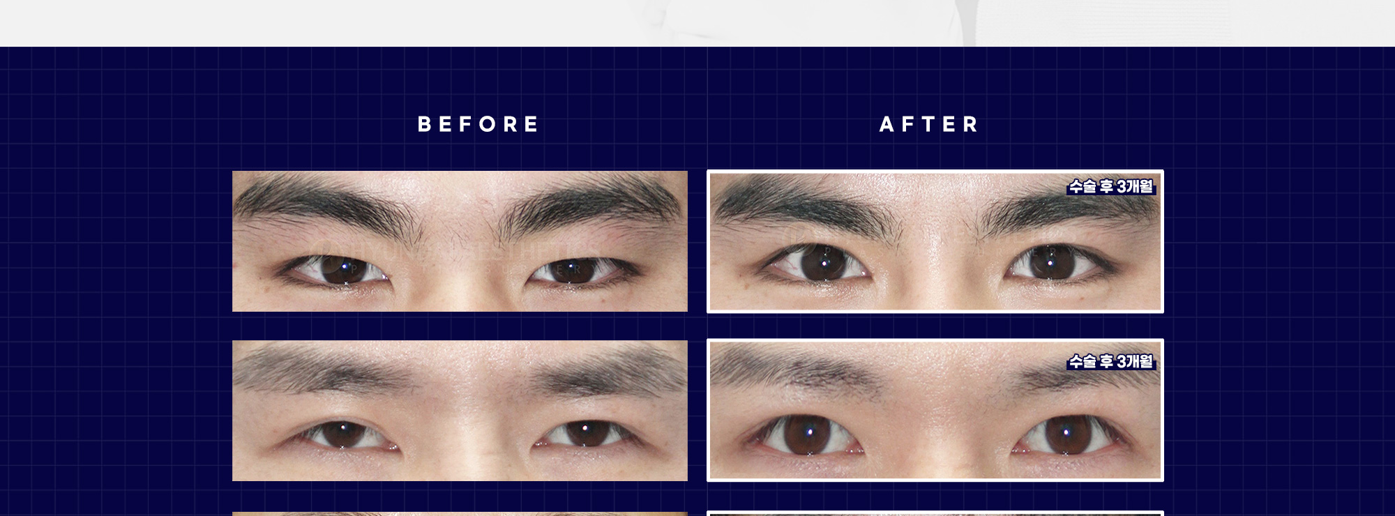 ศัลยกรรมตาผู้ชาย BEFORE & AFTER — หลังผ่าตัด 3 เดือน