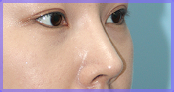 หลังศัลยกรรมแก้ไขจมูกปลายงุ้ม — ภาพด้านข้างของจมูก (AFTER)