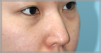 ก่อนศัลยกรรมแก้ไขจมูกปลายงุ้ม — ภาพด้านข้างของจมูก (BEFORE)