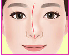 ภาพประกอบจมูกคดแบบ C