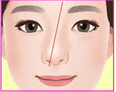 ภาพประกอบจมูกคดแบบเฉียง