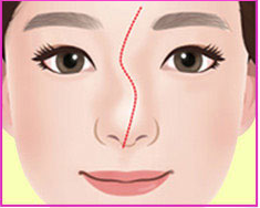 ภาพประกอบจมูกคดแบบ S