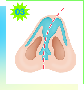 แผนภาพการผ่าตัดกรณีผนังกั้นจมูกคดรุนแรง